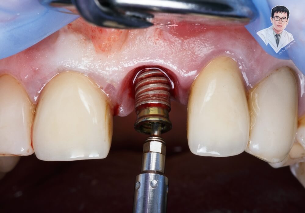 Cận cảnh quá trình đặt trụ Implant vào xương hàm tại vị trí răng cửa, giúp phục hình răng mất với độ chính xác cao.