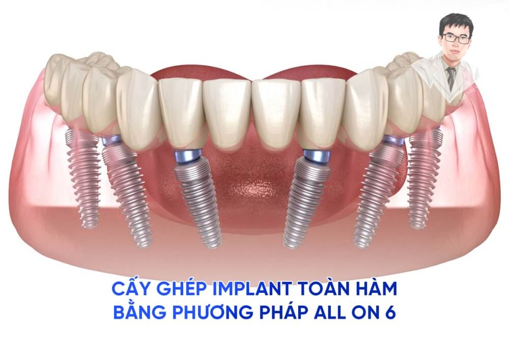Hình ảnh mô phỏng phương pháp cấy ghép răng toàn hàm bằng kỹ thuật All-on-6, giúp phục hình nhanh chóng và hiệu quả.