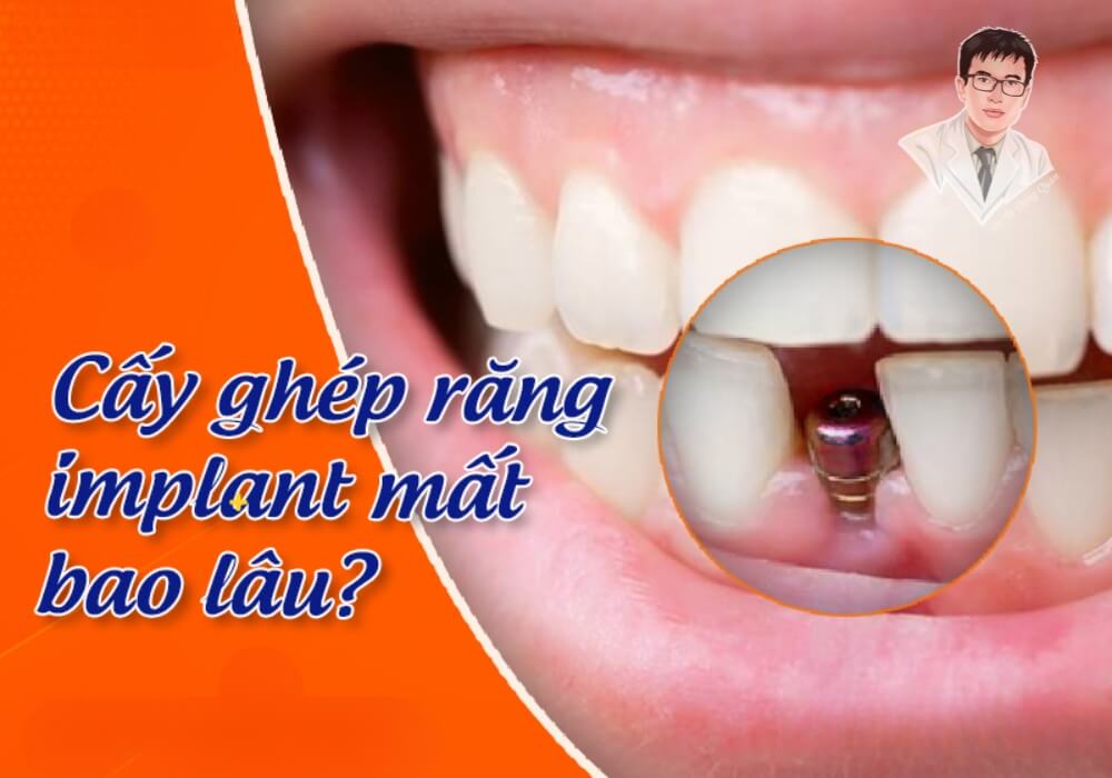 Hình ảnh mô phỏng quá trình cấy ghép răng Implant, giúp bạn hình dung về quy trình thực hiện tại phòng khám.