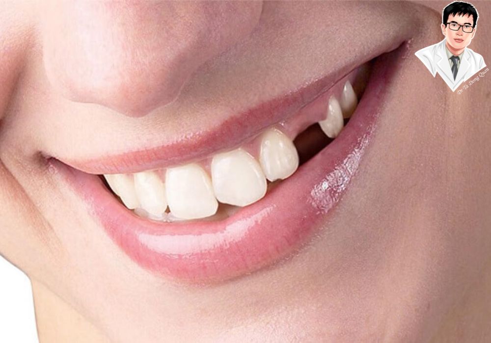 Implant xương hàm trên không chỉ phục hồi chức năng ăn nhai mà còn mang lại nụ cười rạng rỡ và tự tin cho người bệnh.