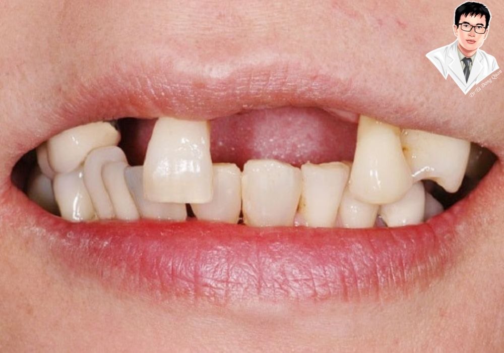 Sau khi cấy ghép implant xương hàm trên, bệnh nhân sẽ có lại nụ cười tự nhiên và khả năng ăn nhai thoải mái