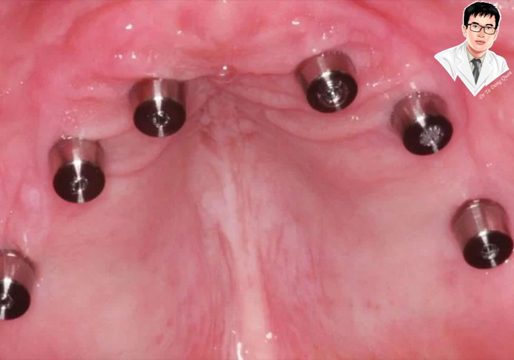 Ghép xương hàm là bước quan trọng trong việc chuẩn bị cho cấy ghép implant, đảm bảo sự ổn định cho trụ implant và giúp phục hồi nụ cười hoàn chỉnh.