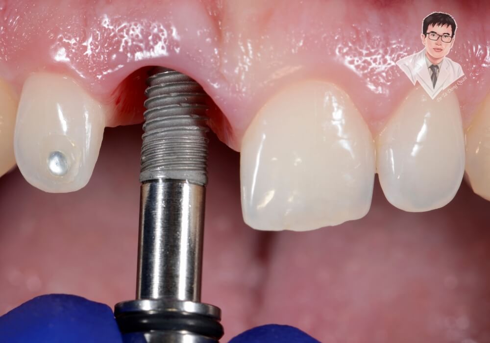 Cận cảnh cấy ghép Implant thật 100% – Không còn là hình minh họa nữa! Hình ảnh cận cảnh thực tế quá trình cấy trụ implant vào nướu răng của bệnh nhân.