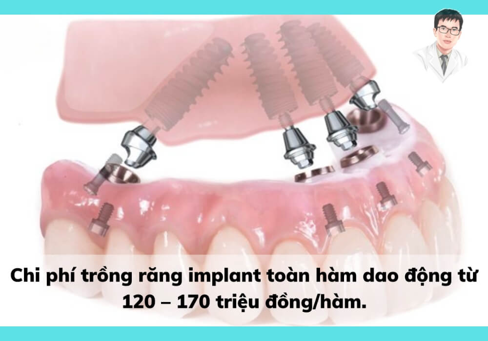 Trồng răng Implant toàn hàm giá bao nhiêu? Cập nhật giá mới nhất 2025! Minh họa chi phí trồng răng Implant toàn hàm dao động từ 120–170 triệu đồng, cập nhật mới nhất năm 2025.