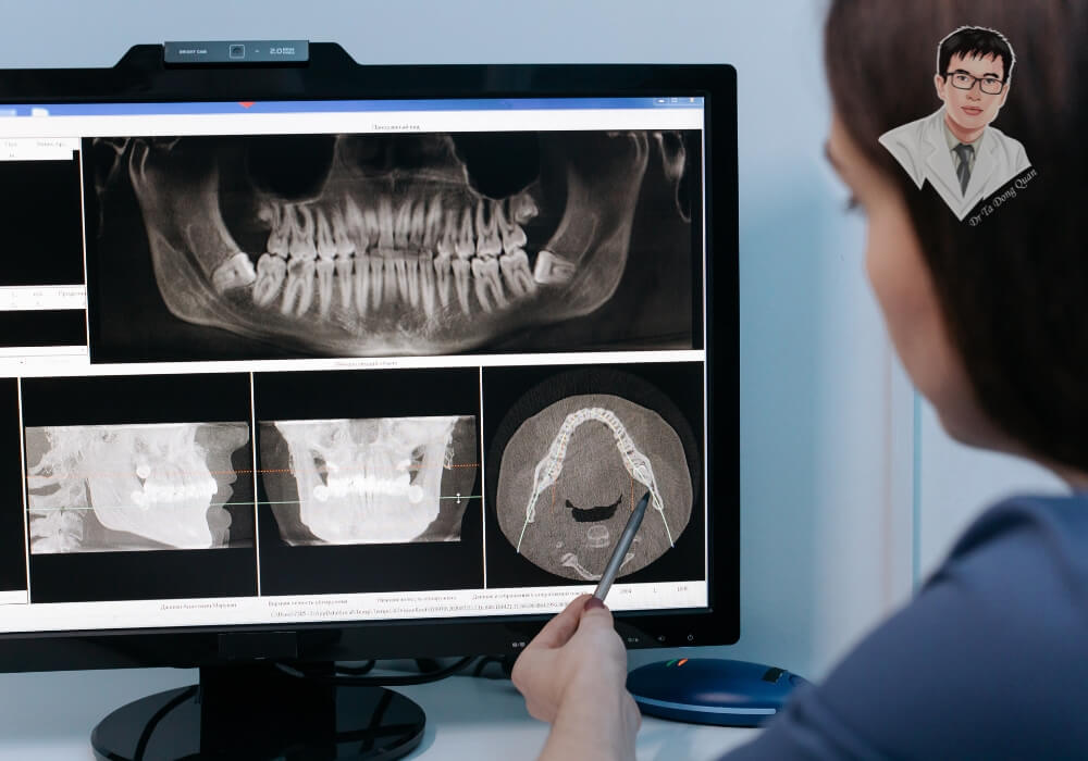 Đừng bỏ qua bước chụp CT 3D – Chìa khóa quyết định thành công và chi phí cấy Implant. Bác sĩ đang phân tích phim chụp CT Cone Beam 3D để đánh giá xương hàm trước khi cấy ghép Implant.