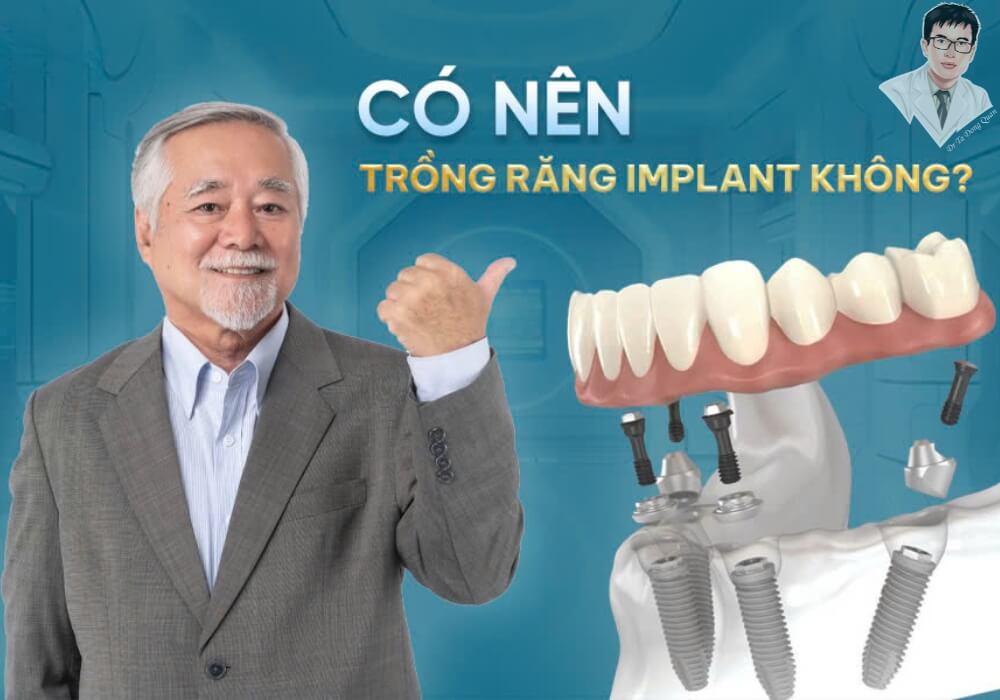 Hình ảnh bác sĩ đang tư vấn có nên trồng răng implant không cùng mô phỏng cấu trúc răng implant.