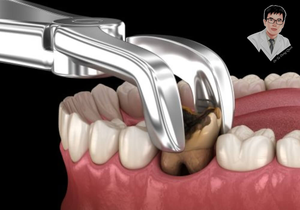 Hình ảnh mô phỏng quá trình nhổ bỏ răng bị hư tổn nghiêm trọng bằng kìm nha khoa, minh họa bước đầu tiên trong lộ trình điều trị bằng phương pháp trồng răng Implant.