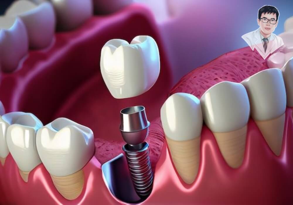 Hình ảnh mô phỏng quá trình trồng răng implant đúng kỹ thuật và đúng thời điểm. Trụ implant được đặt vào trong xương hàm, mô phỏng bước chính trong quy trình trồng răng giả sau khi nhổ.