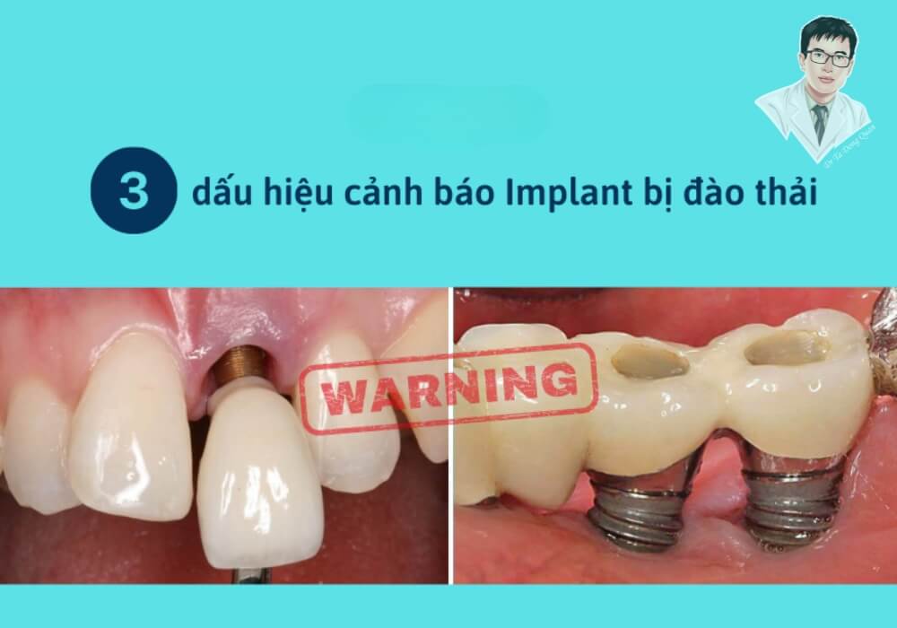 Nhận diện 3 dấu hiệu điển hình giúp bạn phát hiện sớm trồng răng implant bị đào thải! Tổng hợp các biểu hiện phổ biến cảnh báo implant có thể bị đào thải như viêm, tiêu xương, răng lung lay hoặc viêm mủ quanh trụ.
