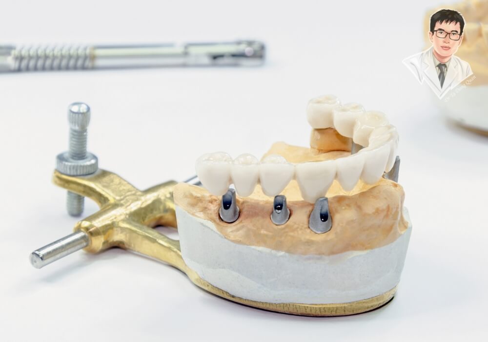 Mô hình hàm răng giả gắn 4 trụ Implant cố định, minh họa kỹ thuật phục hình răng bằng phương pháp cấy ghép Implant toàn hàm trên giá đỡ chuyên dụng.