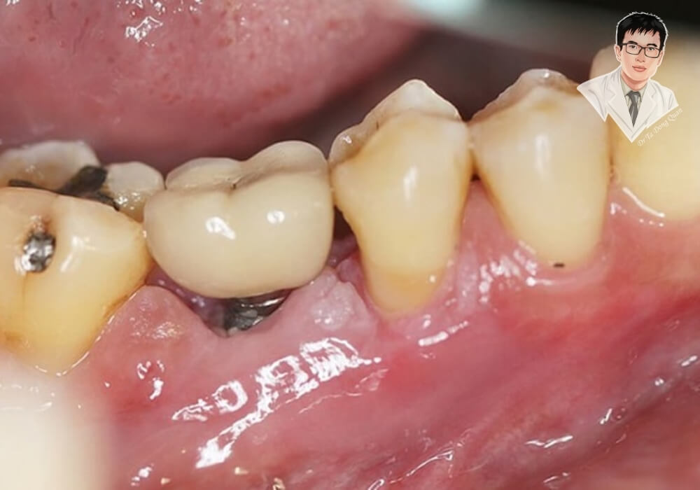 Mô tả chi tiết: Ảnh chụp thực tế vùng nướu sau khi gắn trụ implant, minh họa chi tiết quá trình cấy ghép trong miệng bệnh nhân.