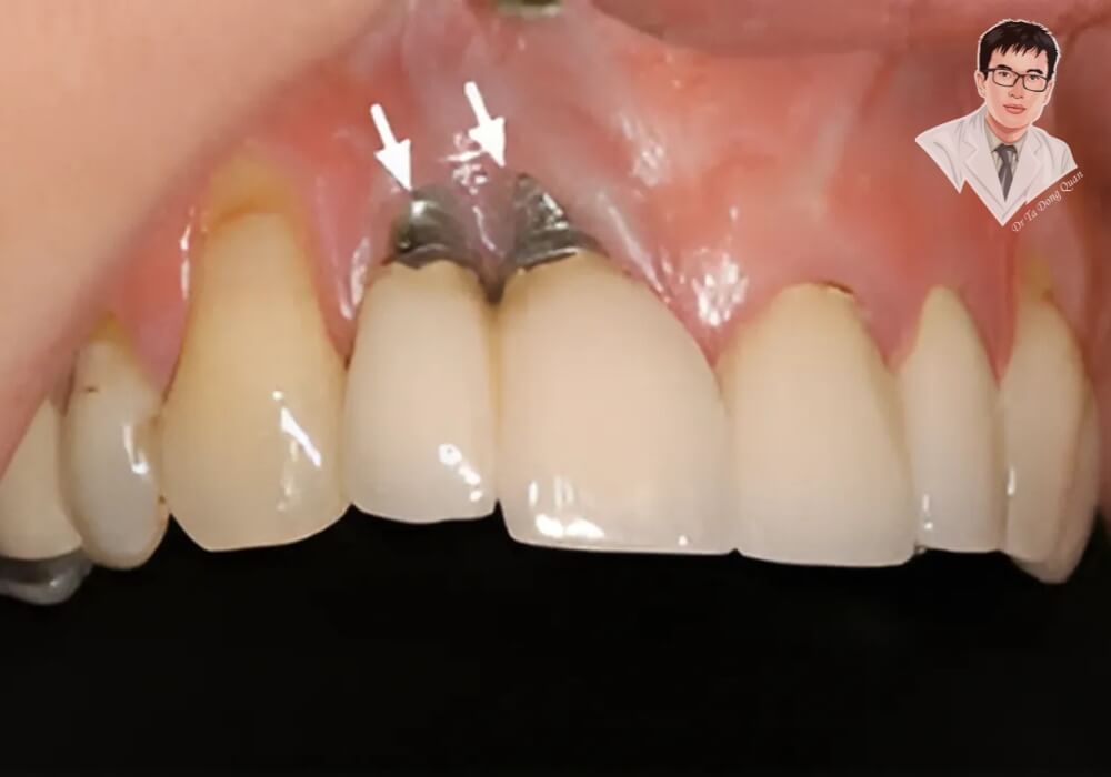 Hình ảnh thực tế trụ implant bị lộ kim loại do tụt nướu sau khi cấy ghép, dấu hiệu cảnh báo tình trạng trồng răng implant bị đào thải.