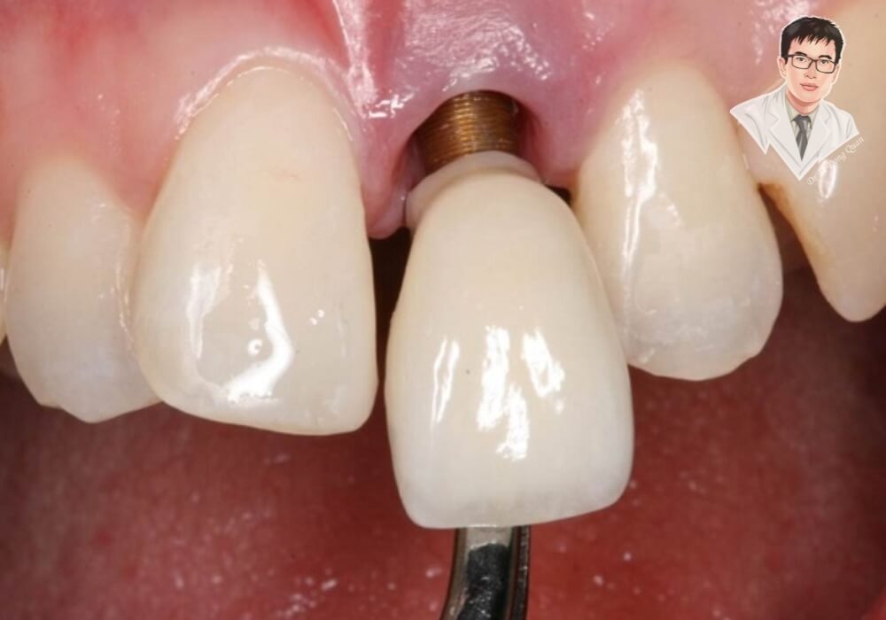 Implant lung lay? Hãy kiểm tra ngay – bạn có thể đang đối mặt với tình trạng đào thải! Trụ implant bị lung lay và lộ chân trụ là dấu hiệu báo động đỏ trước khi bị loại bỏ khỏi xương hàm.