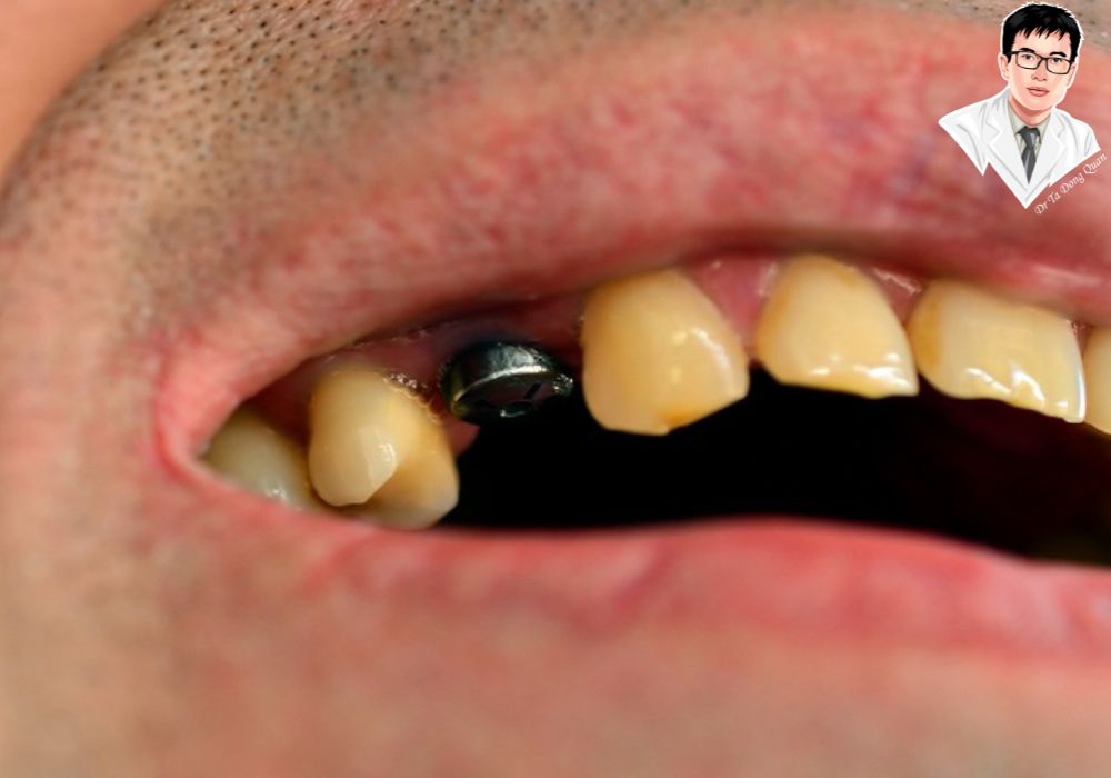 Cấy ghép implant xương hàm trên là giải pháp phục hồi răng mất hiệu quả, giúp duy trì mật độ xương và cải thiện sức khỏe răng miệng lâu dài.