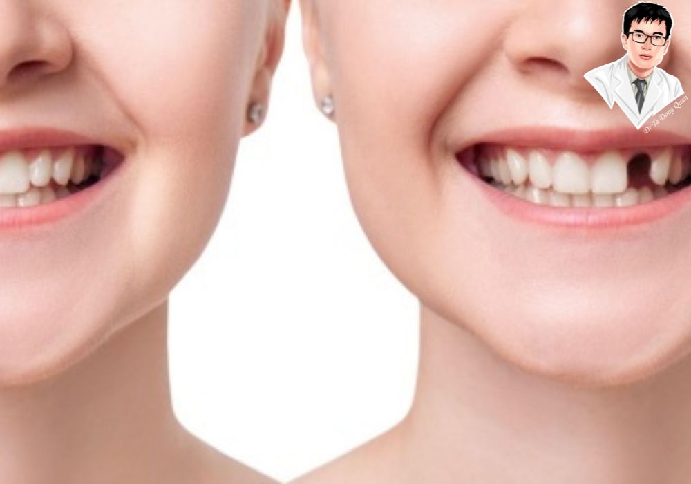 Implant xương hàm trên không chỉ phục hồi chức năng răng miệng mà còn cải thiện thẩm mỹ khuôn mặt một cách rõ rệt.