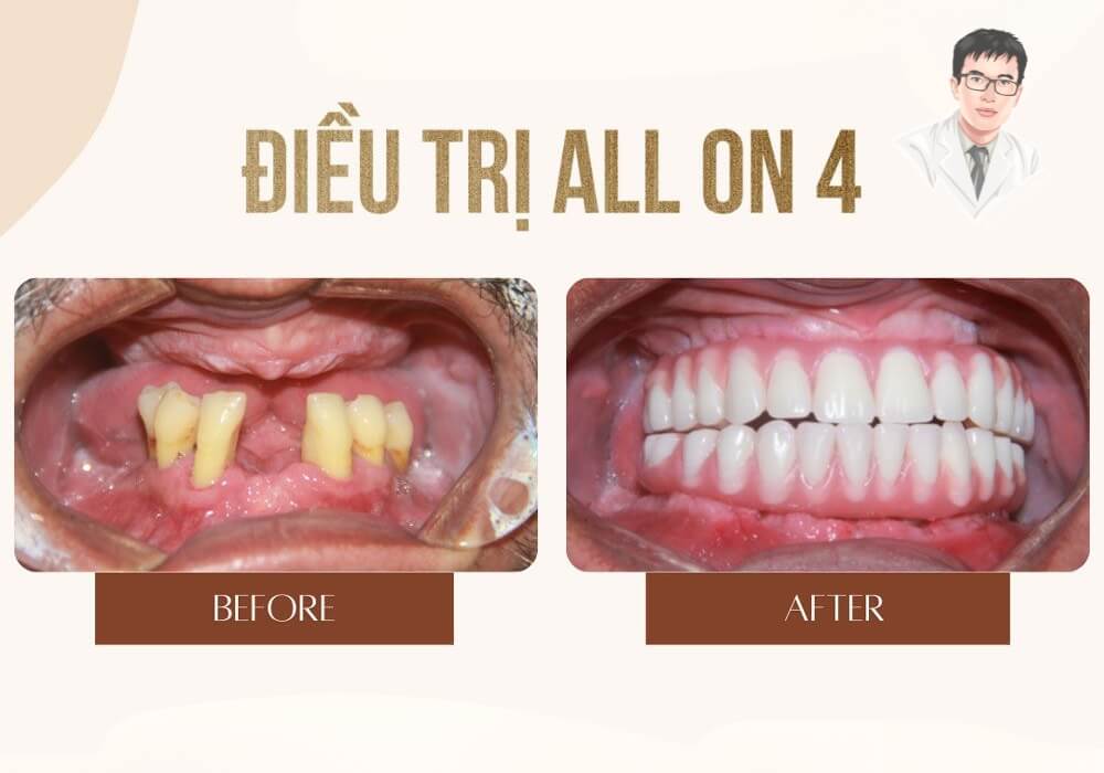 Trước và sau khi trồng răng Implant All On 4 – Hiệu quả vượt mong đợi cả về thẩm mỹ lẫn chức năng! So sánh hình ảnh trước và sau điều trị trồng răng All On 4 – cải thiện rõ rệt cả chức năng ăn nhai và thẩm mỹ khuôn mặt.