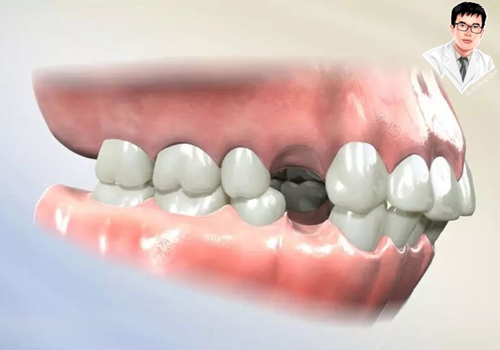 Implant xương hàm trên giúp phục hồi không chỉ chức năng ăn nhai mà còn hình dáng và màu sắc của răng tự nhiên.