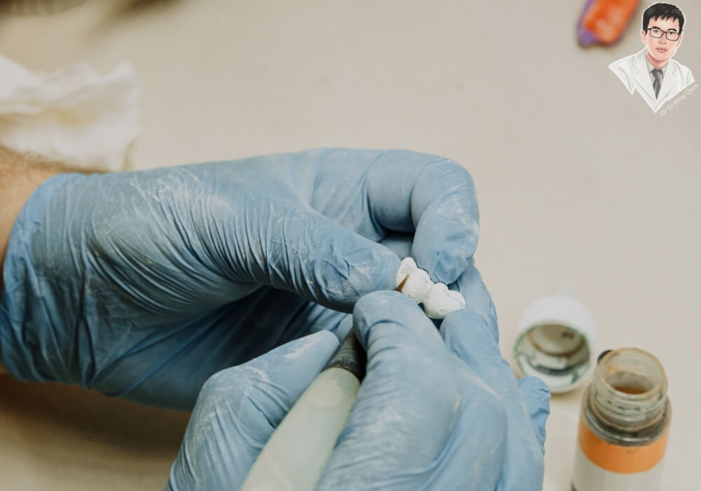 Kỹ thuật viên nha khoa đang chế tác mão sứ bằng tay trong quy trình làm răng Implant, đảm bảo độ chính xác và thẩm mỹ cao trước khi phục hình lên trụ Implant đã cấy.