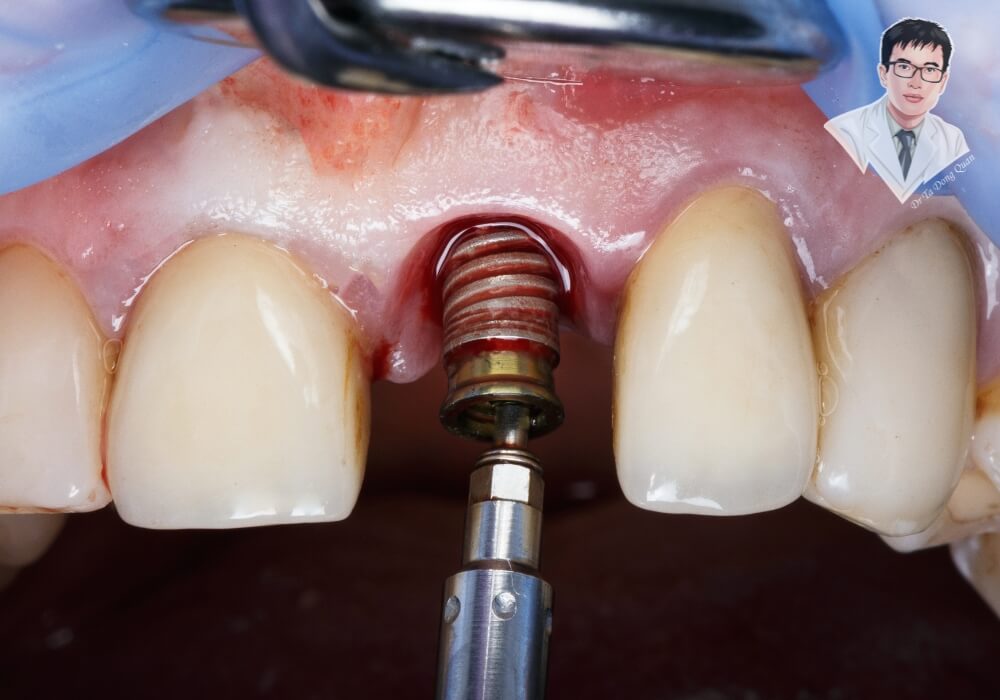 Hình ảnh thực tế quá trình bác sĩ đang cấy trụ titanium vào xương hàm cho bệnh nhân mất răng cửa.