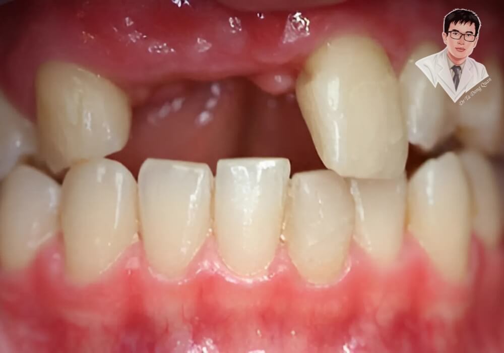 Cận cảnh vùng răng cửa bị mất trước khi tiến hành làm răng Implant, cho thấy rõ ảnh hưởng đến thẩm mỹ.