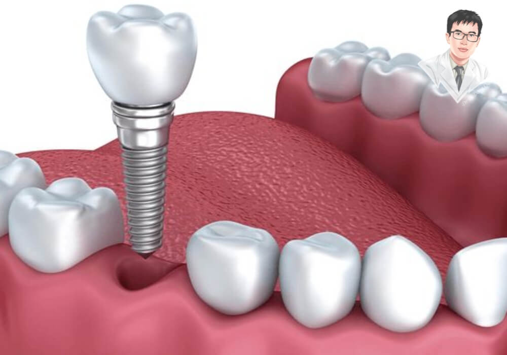 Hình ảnh mô phỏng cấu trúc đầy đủ của một răng Implant gồm trụ, khớp nối và mão sứ gắn cố định.