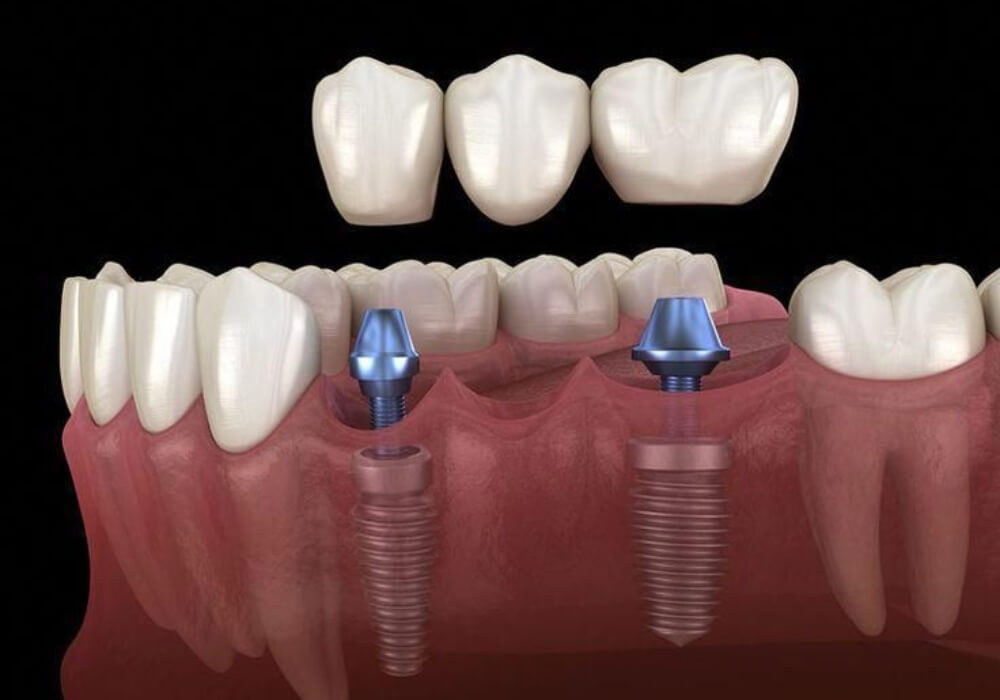 Mô phỏng phục hình nhiều răng mất bằng kỹ thuật Implant kết hợp cầu răng sứ.