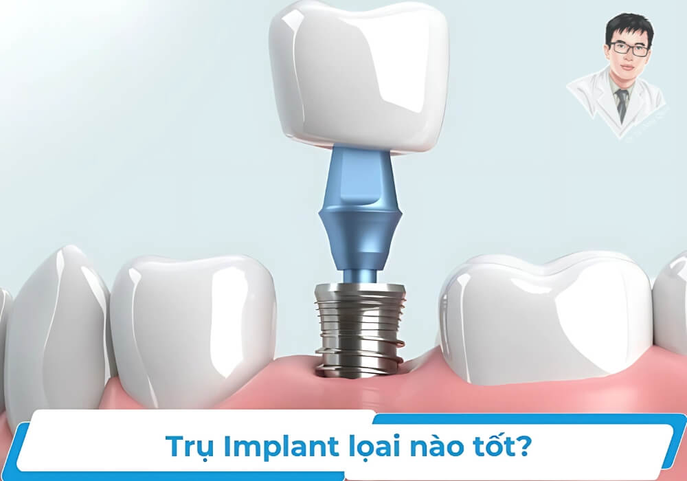 Hình minh họa trụ Implant hiện đại với khớp nối Abutment, giúp tích hợp xương nhanh hơn.