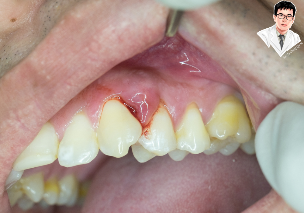 Nếu không được điều trị, bạn có thể đối mặt với nguy cơ tiêu xương hoặc mất implant.