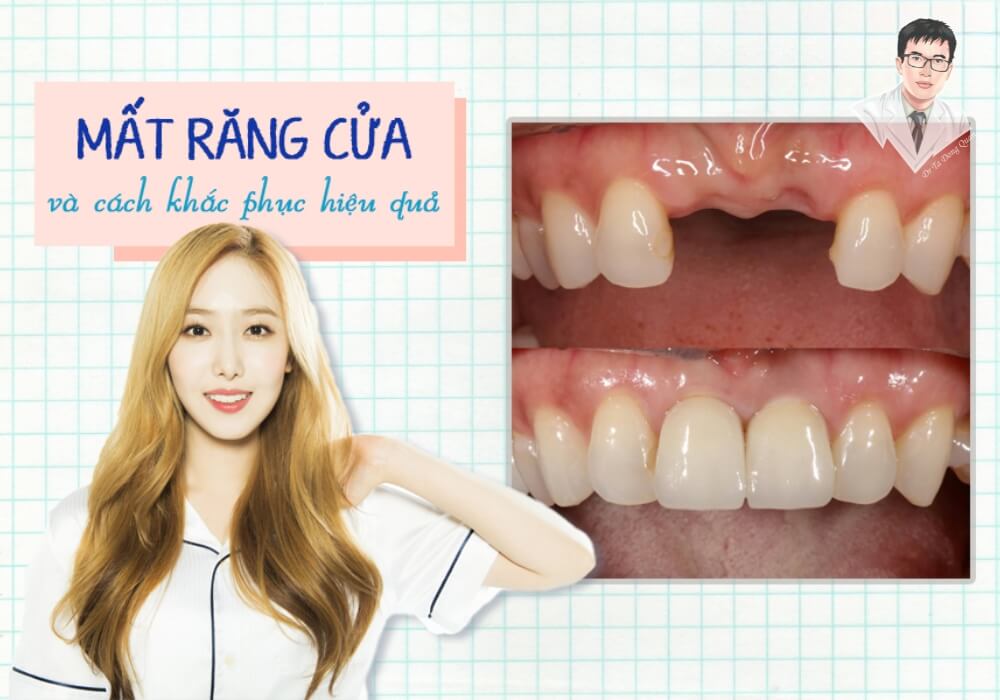 Hình ảnh bệnh nhân mất răng cửa và hậu quả thẩm mỹ trước khi trồng implant răng cửa.