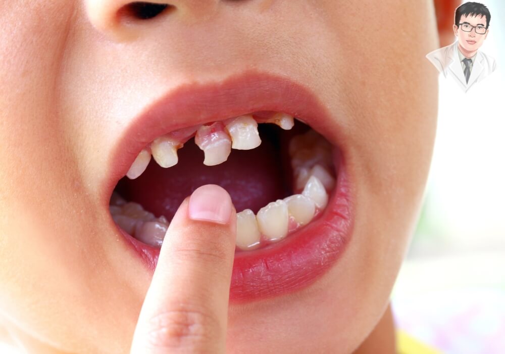 Cận cảnh người bệnh mất răng gây ảnh hưởng đến thẩm mỹ, chức năng ăn nhai và sức khỏe răng miệng.