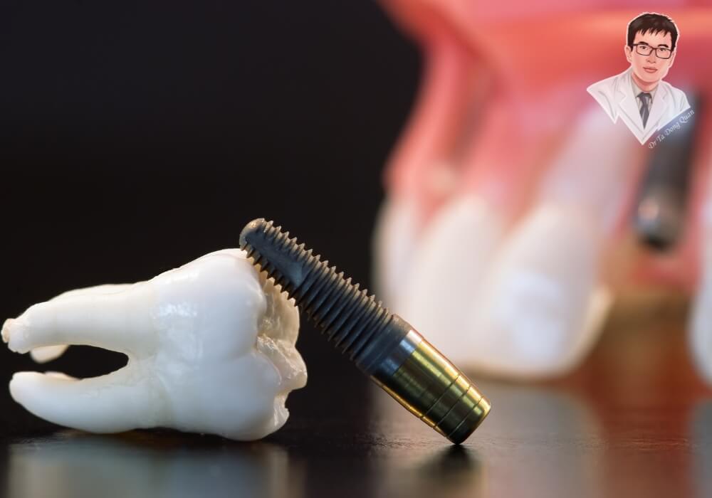 Hình ảnh mô phỏng răng thật bị mất lâu năm và trụ Implant nha khoa, đặt cạnh nhau để minh họa khả năng phục hồi răng mất bằng phương pháp cấy ghép hiện đại.