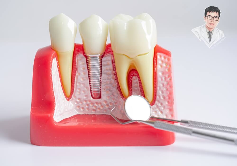Mô hình minh họa cấu tạo răng và vị trí cấy ghép implant chuẩn.