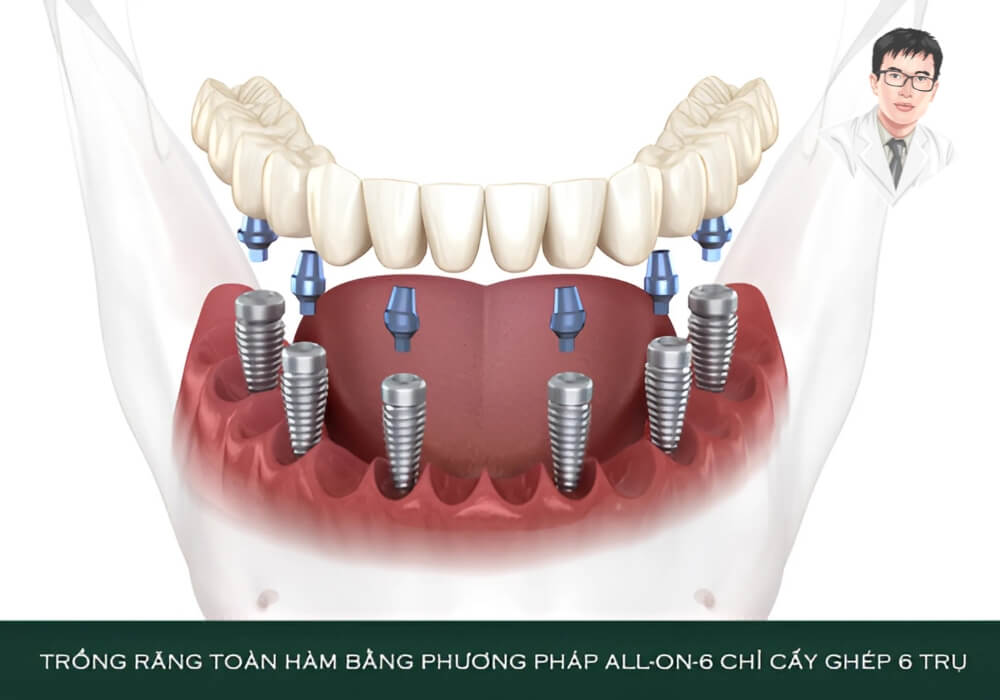 Mô phỏng kỹ thuật cấy ghép 6 trụ Implant trên một hàm, nâng đỡ cầu răng sứ cố định trong phương pháp All On 6.