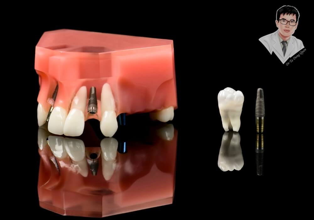 Mô hình minh họa trực quan cấu trúc cấy ghép implant với trụ titanium, mão sứ và mô nướu, được sử dụng trong tư vấn nha khoa.