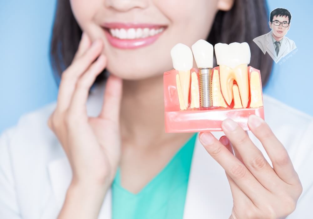 Hình ảnh bác sĩ cầm mô hình răng minh họa quy trình trồng implant sau khi nhổ răng, giúp bệnh nhân hiểu rõ cấu trúc implant.