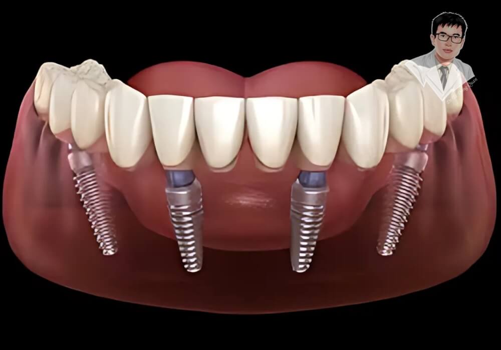 Cận cảnh mô hình All On 4 – Giúp bạn hình dung rõ ràng về cấu trúc trồng răng cố định chỉ với 4 trụ! Mô phỏng kỹ thuật cấy 4 trụ Implant nâng đỡ hàm răng giả cố định All On 4 – cấu trúc ổn định, thẩm mỹ cao.