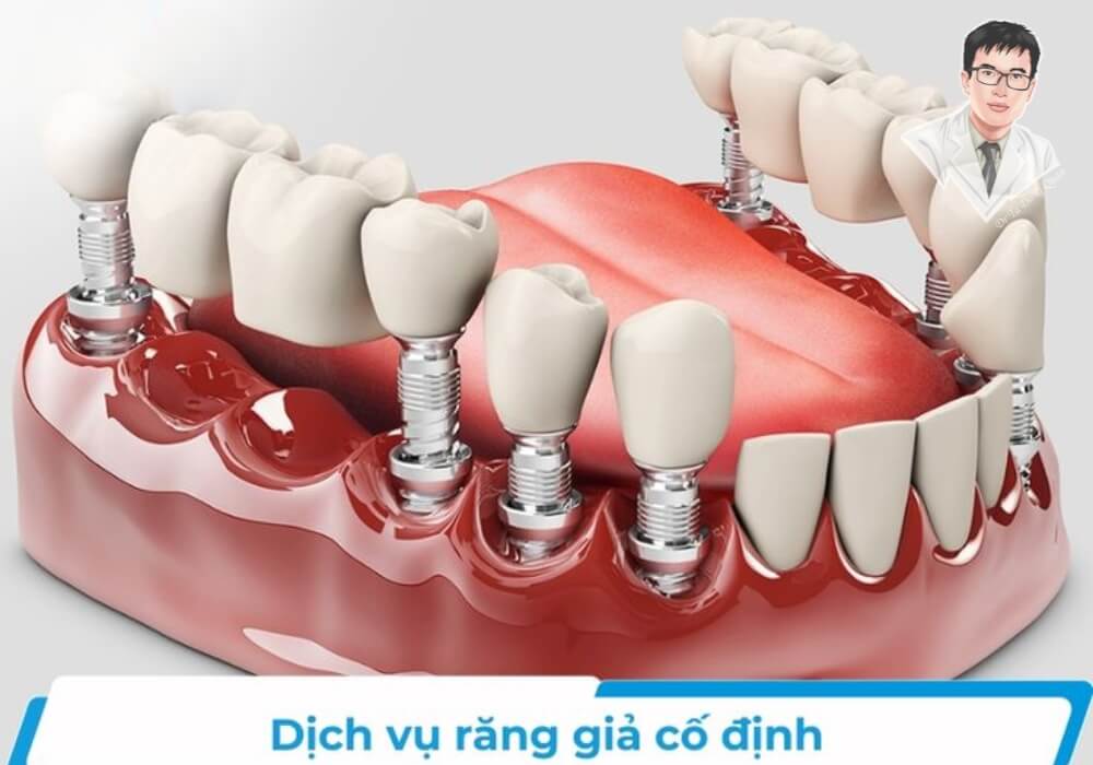 "Quy trình trồng răng Implant mất bao lâu? Tùy vào số lượng răng và kỹ thuật phục hình như thế này." Mô hình cấy ghép răng cố định trên trụ Implant giúp phục hình răng bị mất hiệu quả, phục hồi chức năng ăn nhai.