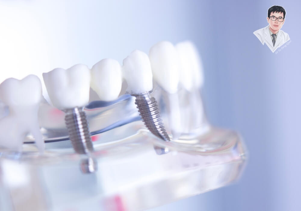 Mô hình Implant với nhiều trụ phục hình nhiều răng liền kề, thể hiện ứng dụng đa dạng của kỹ thuật cấy ghép Implant.