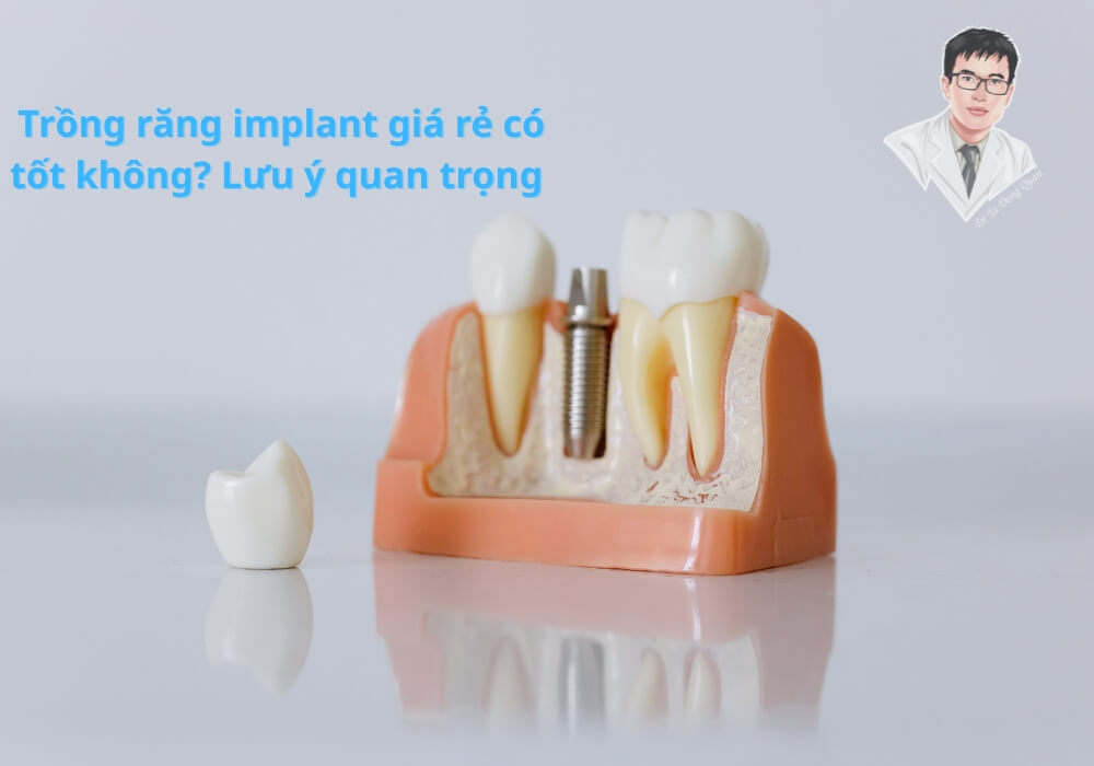 Mô hình minh họa cấu trúc răng implant, giúp người bệnh hình dung rõ quy trình trồng răng implant giá rẻ, an toàn.