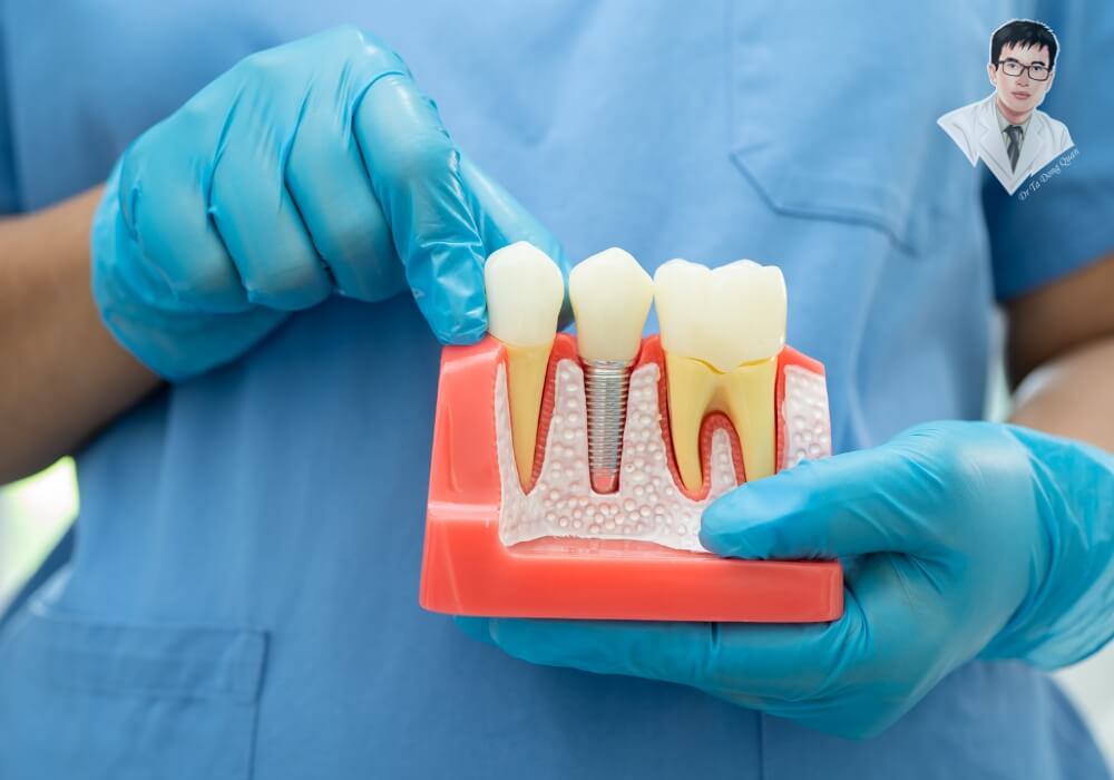 Bác sĩ nha khoa cầm mô hình minh họa cấu trúc răng và quy trình cấy ghép implant hiện đại, giúp bệnh nhân hiểu rõ từng bước.