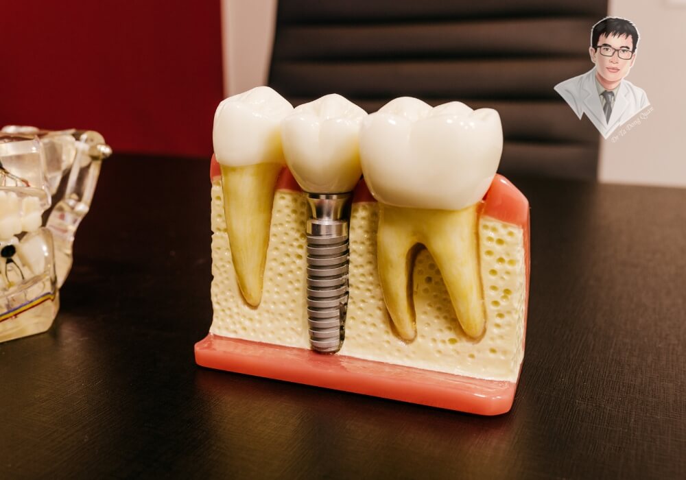 Cấu tạo răng Implant thực tế – Hiểu rõ trước khi quyết định trồng răng giả cố định. Mô hình minh họa cấu tạo răng Implant trên nền xương hàm, gồm trụ Titanium, Abutment và mão sứ, đặt tại phòng tư vấn nha khoa.
