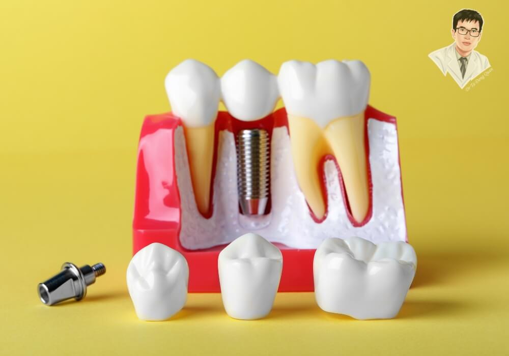 Cấu tạo răng Implant: Giải pháp “chân răng nhân tạo” cho người mất răng! Mô hình cấu tạo răng Implant gồm trụ titanium, Abutment và mão sứ minh họa trực quan quy trình cấy ghép răng giả cố định.