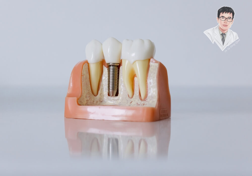 Mô phỏng mô hình răng với trụ Implant được cấy ghép thành công, tạo nền tảng vững chắc cho răng sứ.