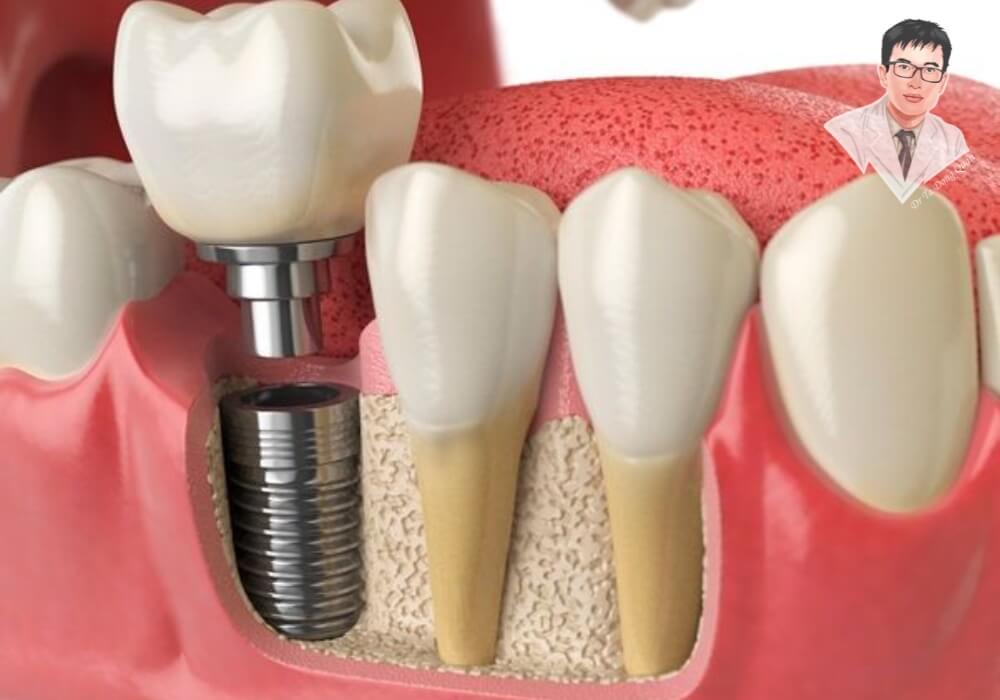 Nhổ răng quá lâu không trồng implant sẽ khiến xương hàm tiêu đi nhanh chóng. Hình ảnh mô phỏng quá trình cấy ghép implant và tiêu xương hàm khi không trồng răng sớm sau nhổ răng.