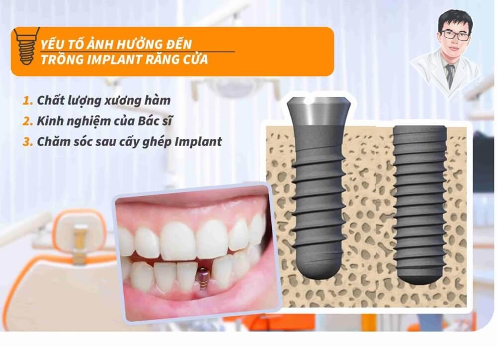 Hình minh họa các yếu tố ảnh hưởng đến thành công khi cấy ghép implant răng cửa.
