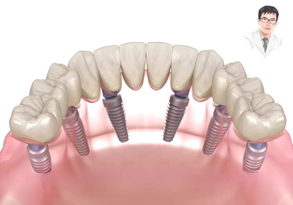 Giải pháp trồng lại răng toàn hàm sau khi implant cũ bị đào thải – an toàn và hiệu quả! Mô phỏng kỹ thuật phục hình răng toàn hàm với nhiều trụ implant sau khi tháo bỏ các trụ cũ bị đào thải.