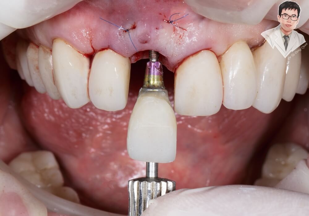 Cận cảnh thực tế quá trình bác sĩ cấy trụ Implant vào xương hàm của bệnh nhân.