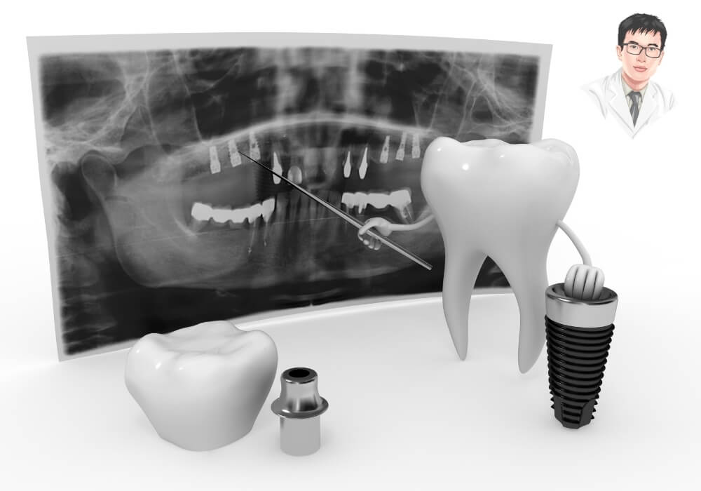 Mô phỏng quy trình cấy ghép implant với hình ảnh X-quang, trụ implant và răng giả. Là bước bắt buộc để đảm bảo trồng răng không đau và chính xác.