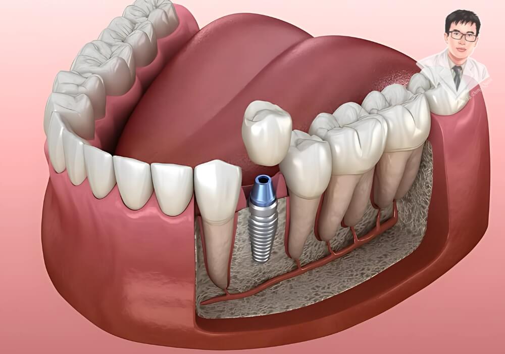 Mô hình giải phẫu 3D cho thấy quá trình đặt trụ implant trong xương hàm và các vị trí răng xung quanh.