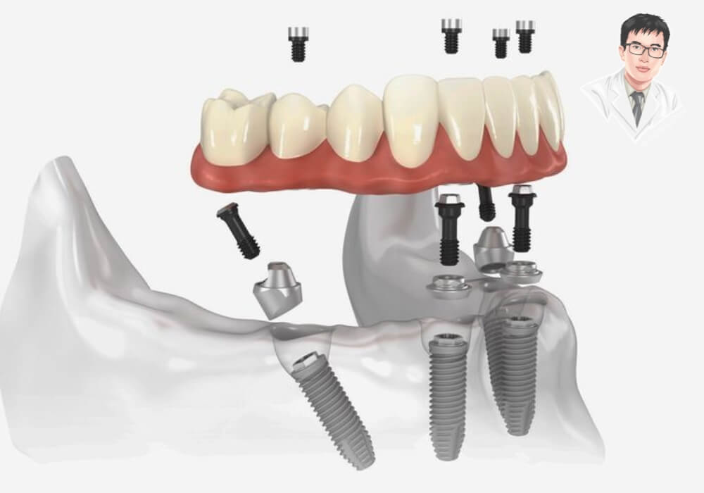 Hình minh họa từng bước cấy ghép implant: đặt trụ vào xương hàm, gắn khớp nối và mão răng, mô phỏng rõ nét quy trình nha khoa.